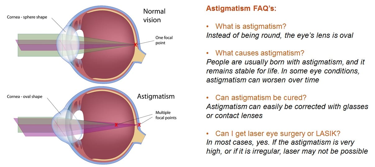 Astigmatism.