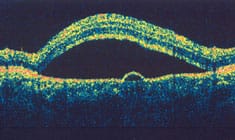Central serous retinopathy.