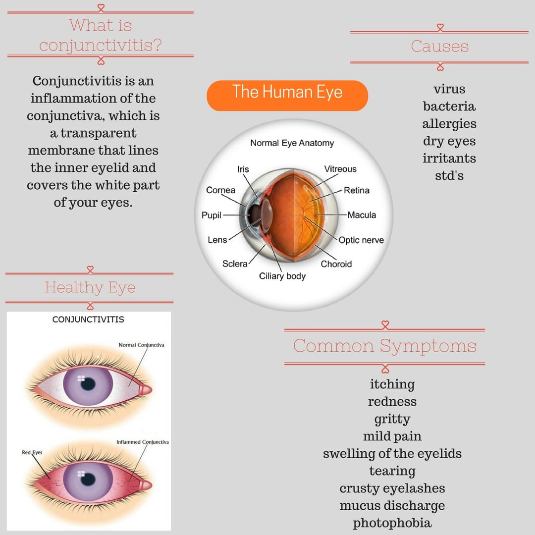 Conjunctivitis, also known as Pink Eye.