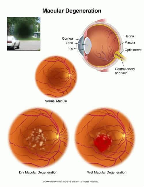 Your Eye Test For Macular Degeneration The Eye Practice