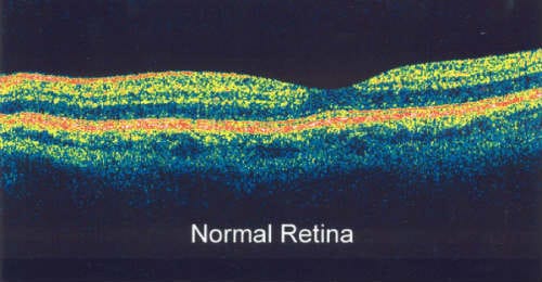 Normal retina OCT.