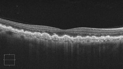 OCT dry macular degeneration.