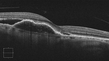 OCT wet macular degeneration.