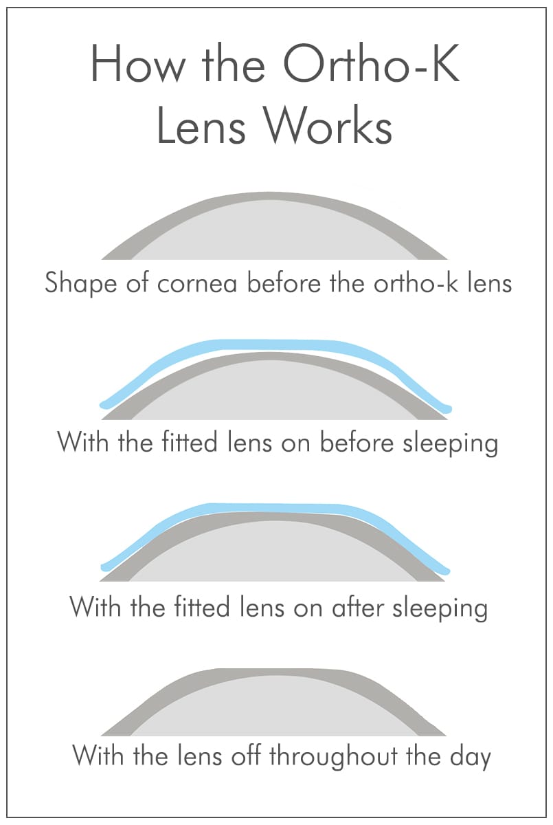 How does Ortho-k work?