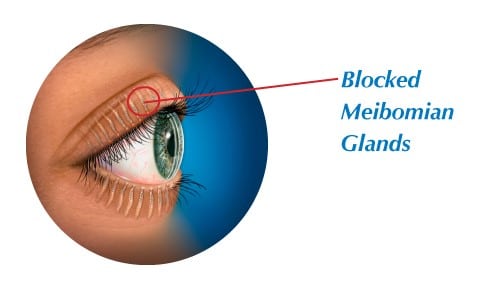 Blocked meibomian glands.