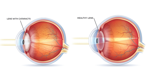 Cataract.