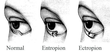 Ectropion versus entropion.