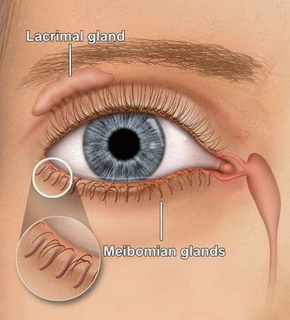 Meibomian glands lipiflow.