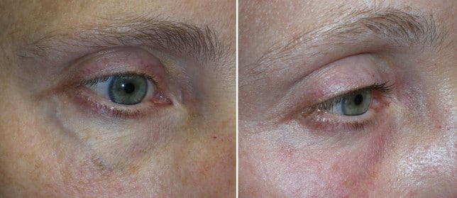 Ocular rosacea.