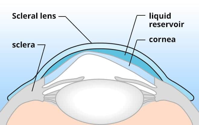 A scleral lens diagram.