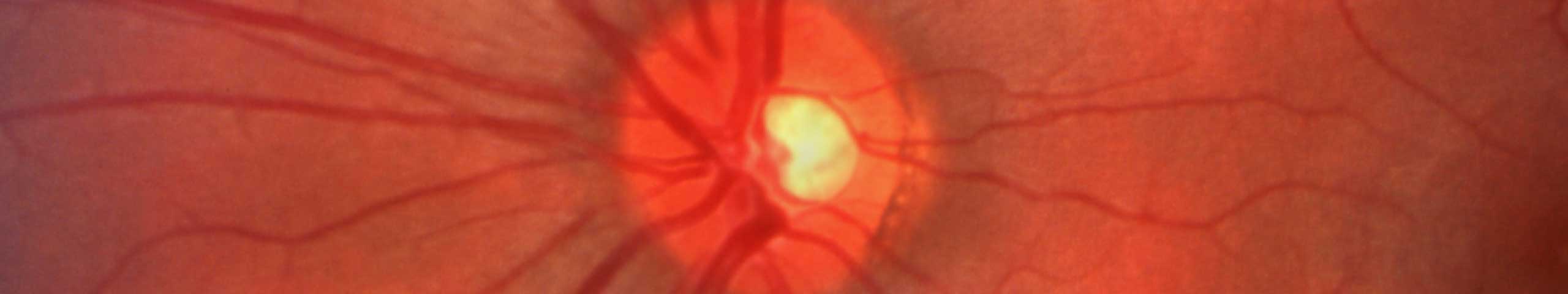 Macular hole.