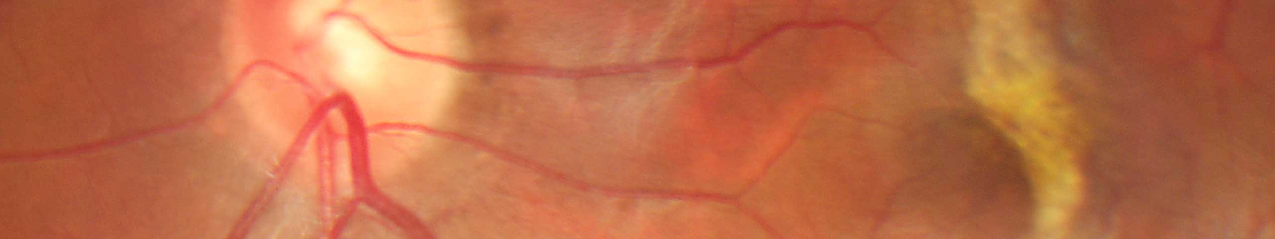 Macular pucker / pre-retinal membrane.