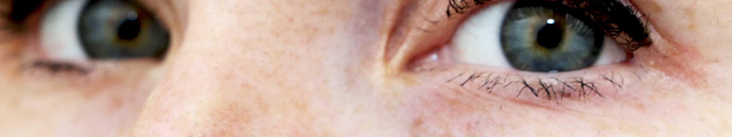 Ocular Rosacea.
