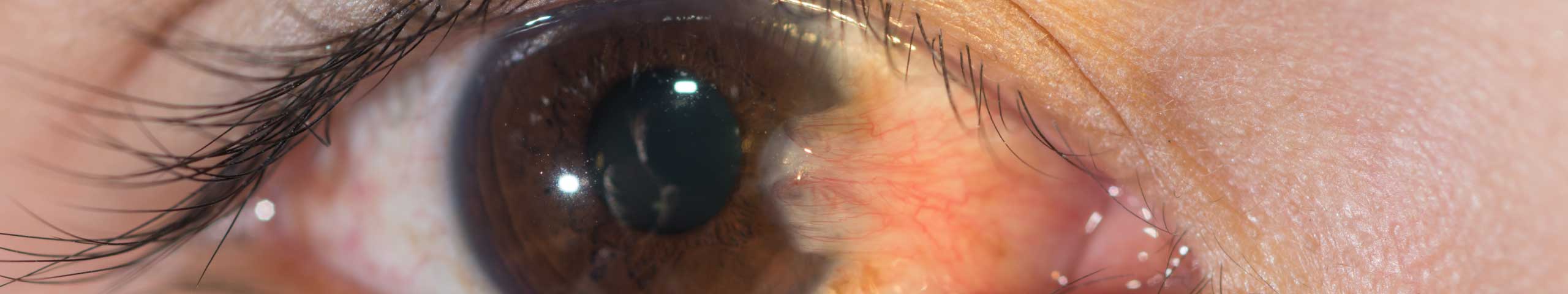 Pterygium.