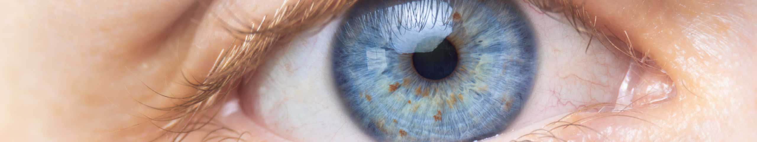 Recurrent Corneal Erosion.