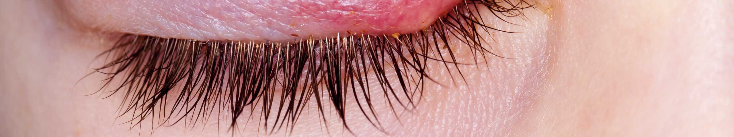 Stye.