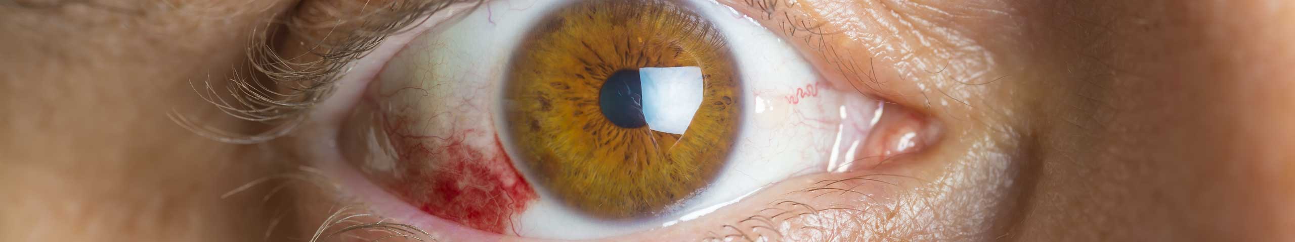 Subconjunctival haemorrhage.