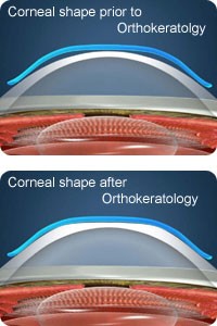 Corneal shape Ortho-K lens.