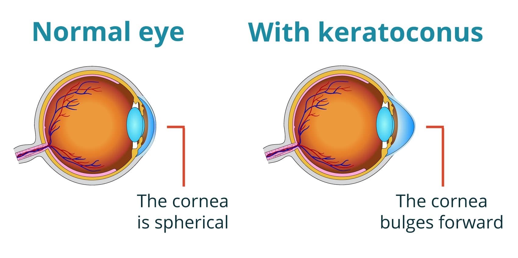 Cross section of a normal eye and an eye with keratoconus.