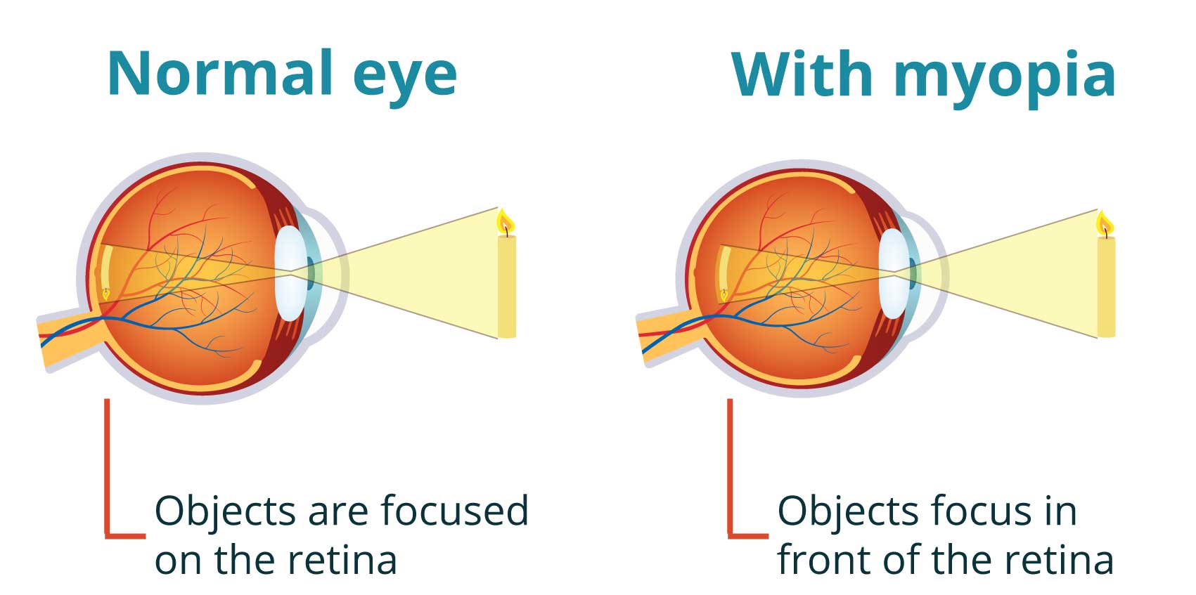 Cross section of a normal eye and an eye with myopia.