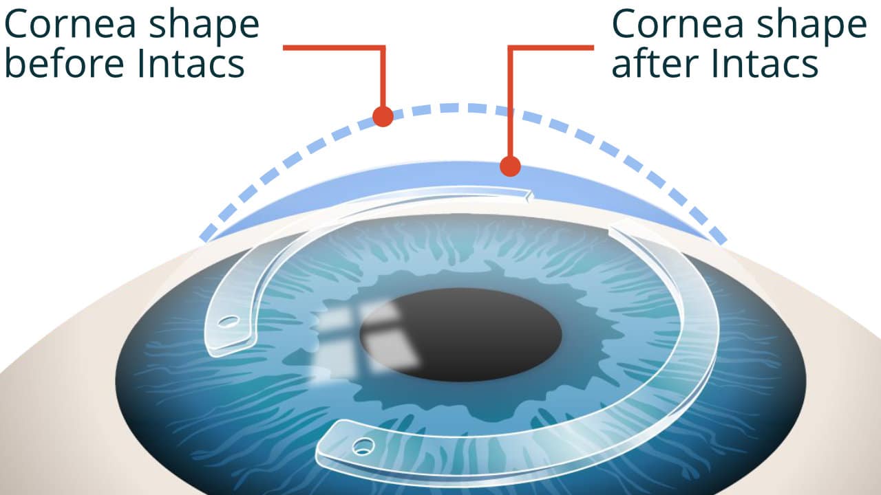 How Intacs treat keratoconus.