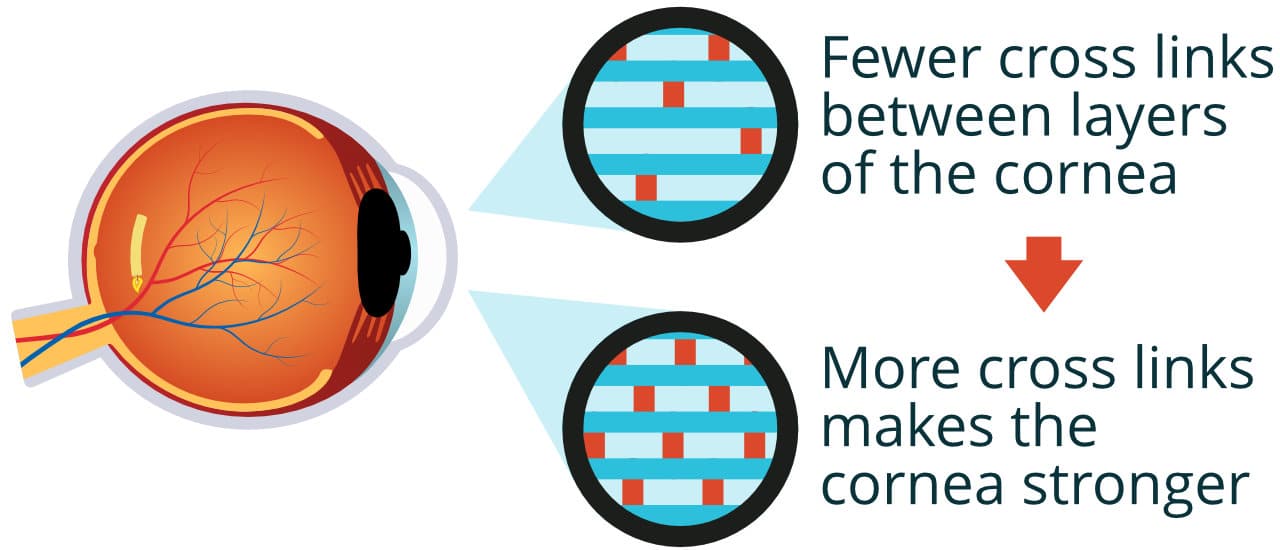 Corneal cross linking is a keratoconus treatment.