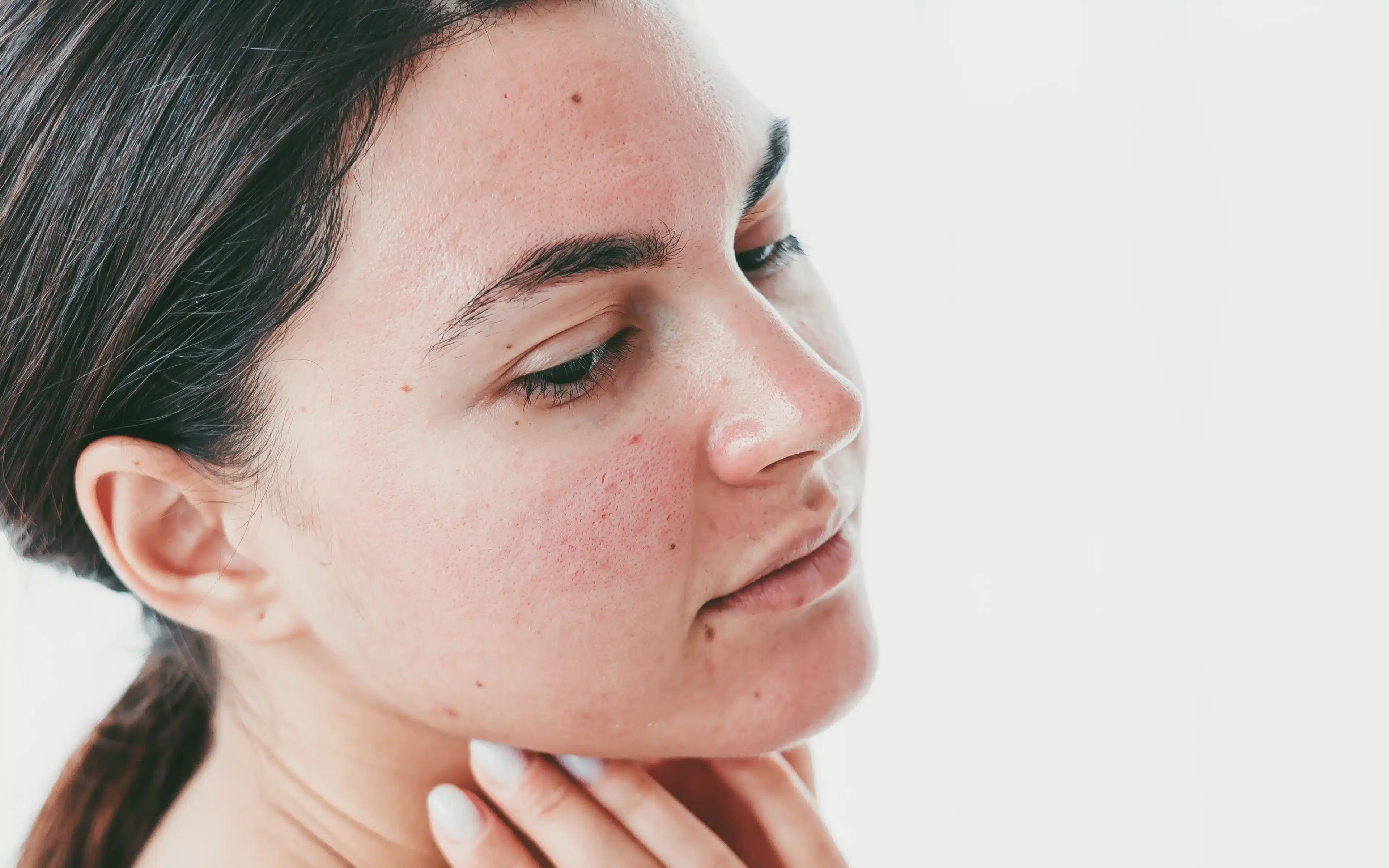 A woman with facial redness – rosacea.