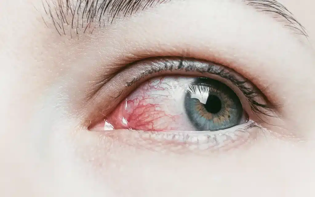 Close up of a severe bloodshot red eye.
