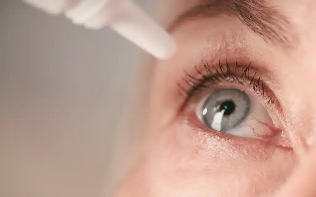 Close-up of a red, irritated eye with drops applied to treat dry eyes caused by rosacea
