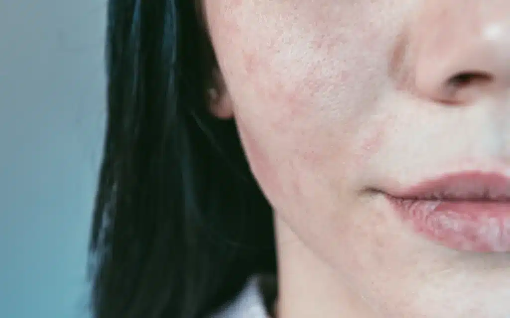 Close-up of a woman's face showing rosacea skin symptoms including facial redness and flushing linked to dry eyes